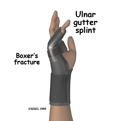 adult_hand_fx_ulnar_gutter_splint
