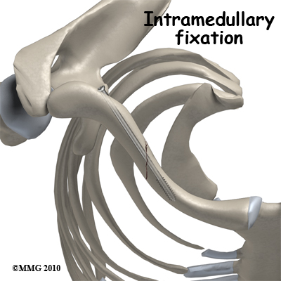 adult_shoulder_fx_clavicle_IM_rod