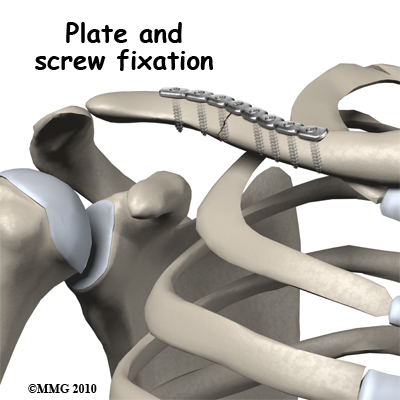 adult_shoulder_fx_clavicle_plate