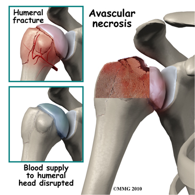 adult_shoulder_fx_humerus_AVN