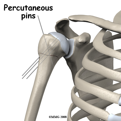 adult_shoulder_fx_treatment04