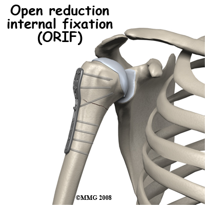 adult_shoulder_fx_treatment05