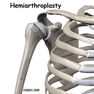 adult_shoulder_fx_treatment07