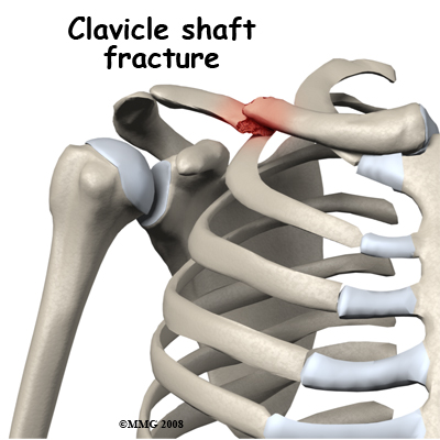 adult_shoulder_fx_type_clavicle_shaft