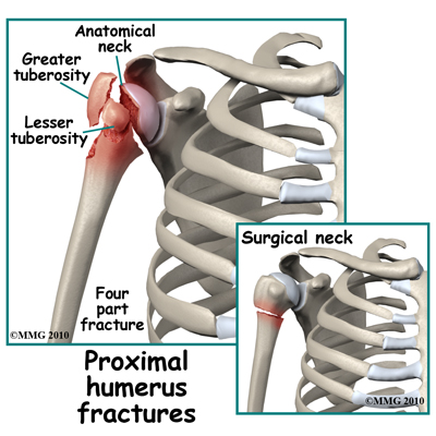 adult_shoulder_fx_type_proximal_humerus