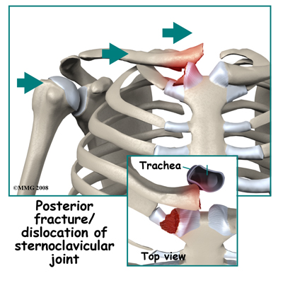adult_shoulder_fx_type_scjoint_posterior_fxdislocate