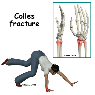 adult_wrist_fx_causes_colles