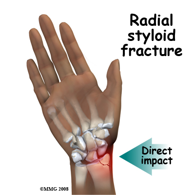 adult_wrist_fx_causes_radial_styloid