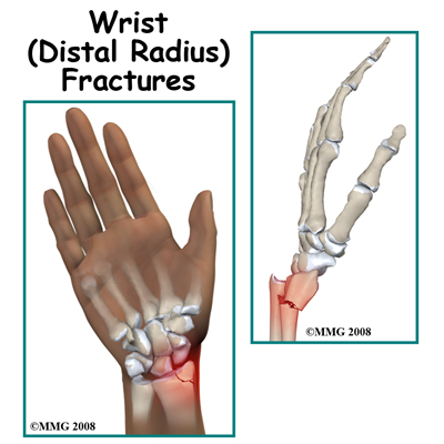 adult_wrist_fx_intro01