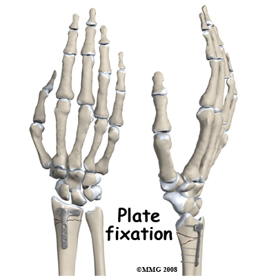 adult_wrist_fx_treatment05