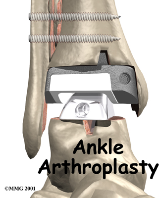 ankle_arthroplasty_intro01
