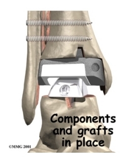 ankle_arthroplasty_surgery07