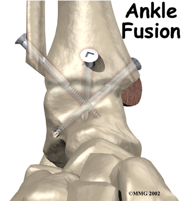 ankle_fusion_intro01