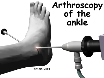 ankle_fusion_surgery01