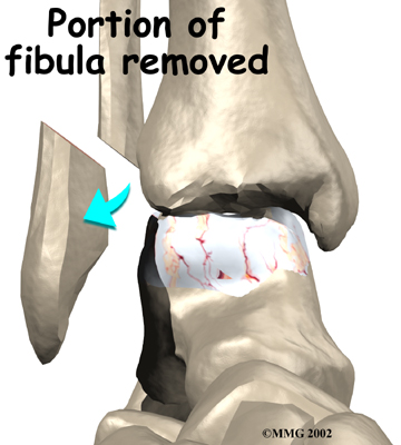 ankle_fusion_surgery02