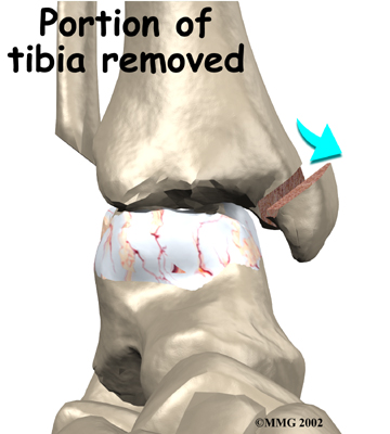 ankle_fusion_surgery03