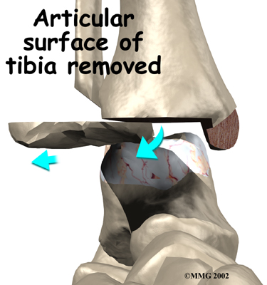 ankle_fusion_surgery04