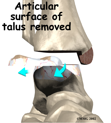 ankle_fusion_surgery05