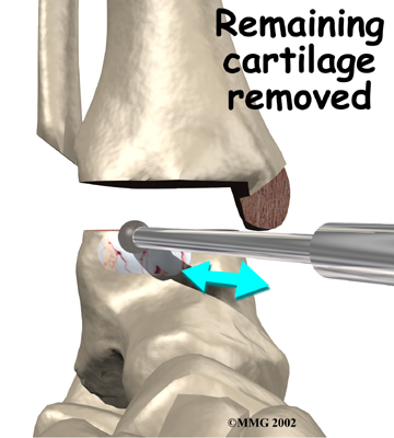 ankle_fusion_surgery06