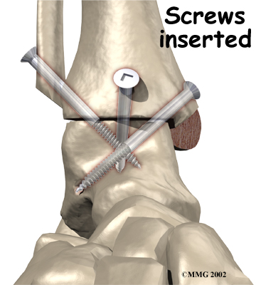 ankle_fusion_surgery07
