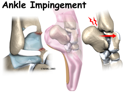 ankle_impingement_intro01