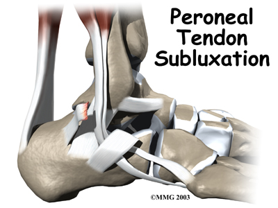 ankle_peroneal_sublux_intro01