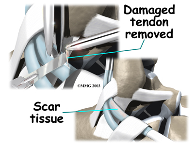ankle_peroneal_tendinitis_surgery02