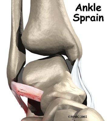 ankle_sprain_intro01
