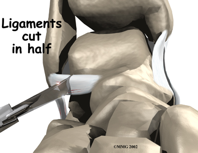 ankle_sprain_surgery01