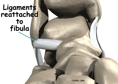 ankle_sprain_surgery03
