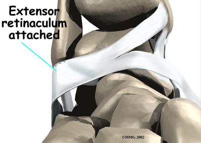 ankle_sprain_surgery04