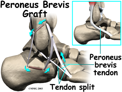 ankle_sprain_surgery05