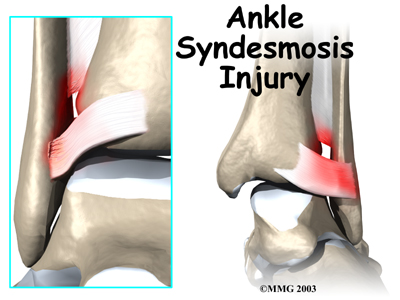 ankle_syndesmosis_intro01