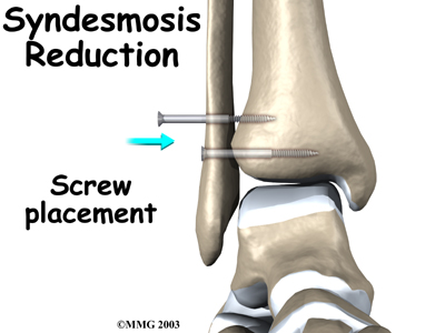ankle_syndesmosis_surgery01