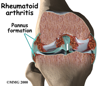 arthritis_RA_intro01