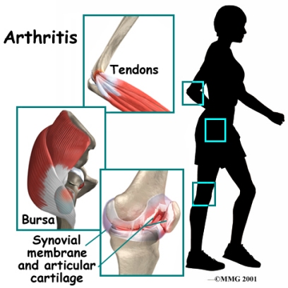 arthritis_general_intro01
