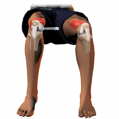 arthritis_inject_intro01