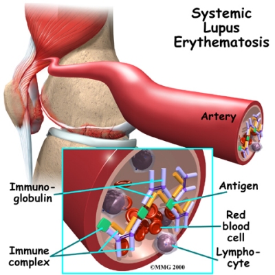 arthritis_lupus_lupus01