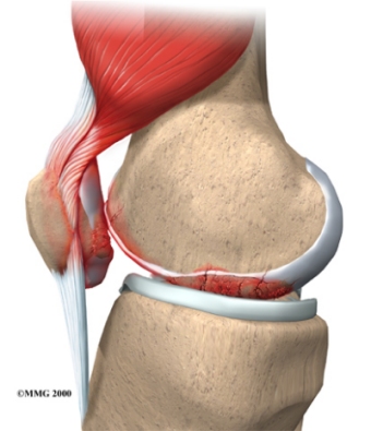 arthritis_lupus_lupusknee