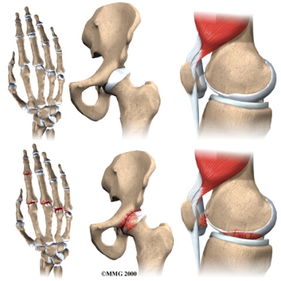 arthritis_osteo_arthritisgrp