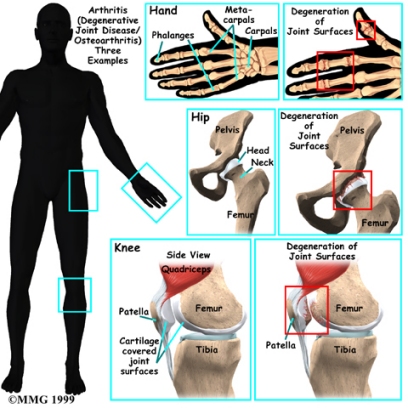 arthritis_osteo_intro01