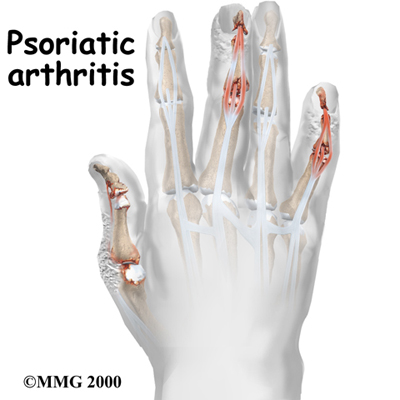 arthritis_psoriatic_intro01