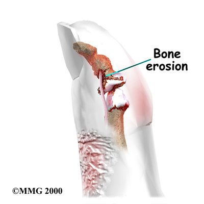arthritis_psoriatic_intro02