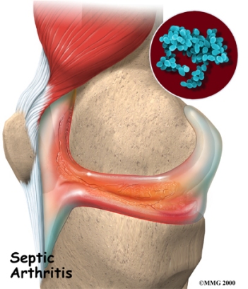 arthritis_septicarthritis01