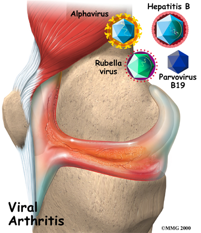 arthritis_viral_arthritis01