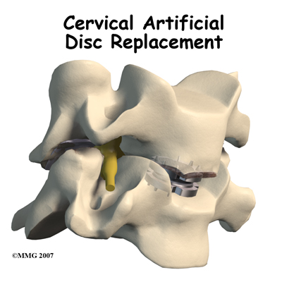 cervical_ADR_intro01