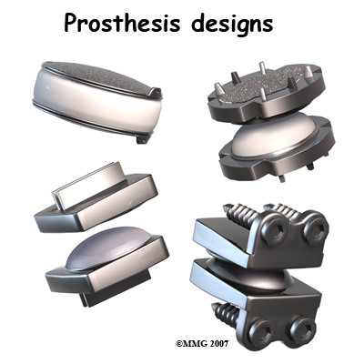 cervical_ADR_prosthesis01