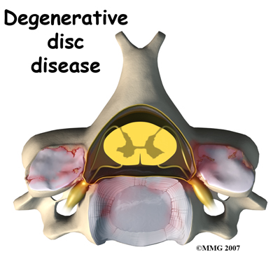 cervical_ADR_rationale01