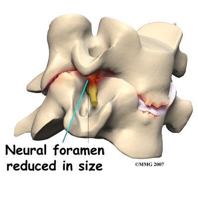 cervical_ADR_rationale02