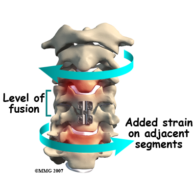 cervical_ADR_rationale03